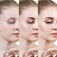 Cargar imagen en el visor de la galería, Crema facial contra el acné / Acnix Cream
