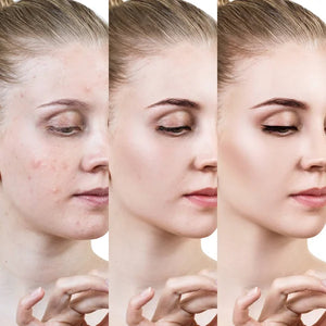 Crema facial contra el acné / Acnix Cream