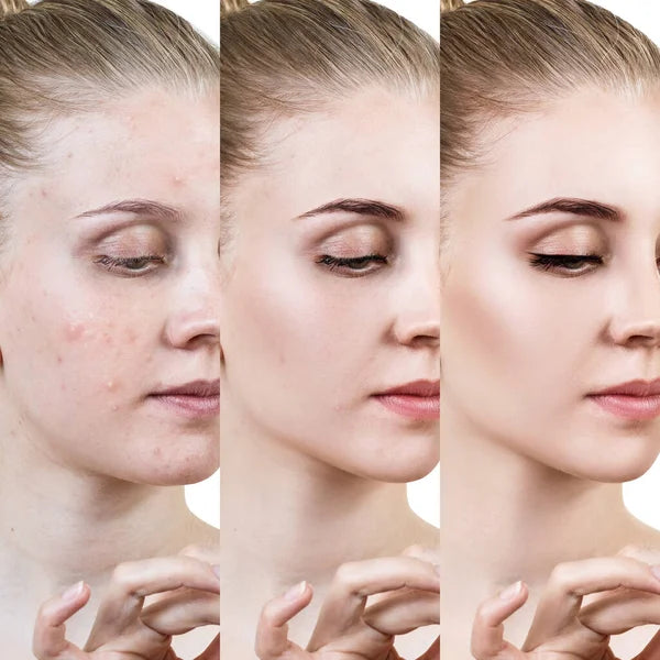 Crema facial contra el acné / Acnix Cream