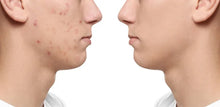 Cargar imagen en el visor de la galería, Crema facial contra el acné / Acnix Cream
